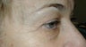 Upper Blepharoplasty, IPL