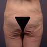 Butt Augmentation