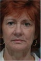 Upper and Lower Blepharoplasty or Eyelid Lift, Eye Bags treatment