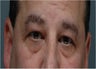 Eyelid Lift, Blepharoplasty, Eye Bags Treatment