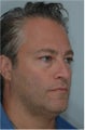 Blepharoplasty, Eyelid Lift, Chemical Peel, Fat Injections