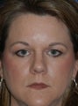 Eyelid Surgery