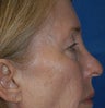 Blepharoplasty
