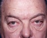 Blepharoplasty
