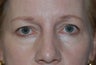 Blepharoplasty