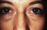 Blepharoplasty