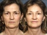 Eyelid Surgery & Facelift