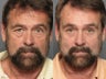 Endoscopic Forehead/Midface Lift, Upper and Lower Eyelids