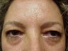 Blepharoplasty