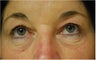 upper and lower Laser Blepharoplasty-Eyelid Surgery