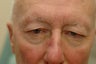 Bilateral upper blepharoplasty