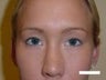 Eyelid Surgery (Blepharoplasty)