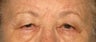 Upper and Lower Lid Blepharoplasty