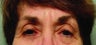 Ptosis Repair