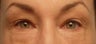 Upper and Lower Lid Blepharoplasty