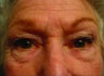 Four lid Blepharoplasty