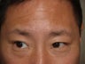 Lower Lid Blepharoplasty