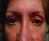 Ptosis Repair
