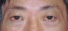 Upper and Lower Blepharoplasty