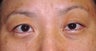 Upper Blepharoplasty