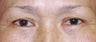 Upper Blepharoplasty