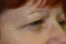 Upper eyelid surgery or blepharoplasty