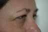 Brow lift, upper and lower eyelid surgery