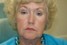 Ptosis repair with upper and lower eyelid surgery
