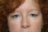 Bilateral upper and lower eyelid surgery