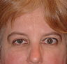 Ptosis repair and eyelid retraction surgery