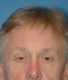 Eyelid Surgery