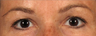 Upper Eyelidplasty with TCA Peel Lower Lids