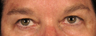 Upper and Lower Eyelidplasty