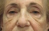 Browlift, ptosis repair, lower bleph and cheek lift