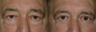 4 Lid Blepharoplasty