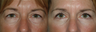 4 Lid Blepharoplasty
