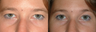 Bilateral Upper Lid Blepharoplasty with Standard Endoscopic Browlift