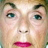 Lower Blepharoplasty