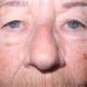 Upper Blepharoplasty
