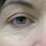 Laser Blepharoplasty