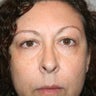 Blepharoplasty