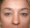 Blepharoplasty