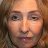 Blepharoplasty