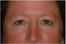 Upper Blepharoplasty