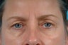 upper lid belpharoplasty