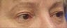 Eyelid Surgery