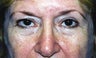 Blepharoplasty