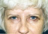 Blepharoplasty