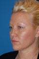 Blepharoplasty or "eyelid lift"
