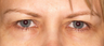 Blepharoplasty (eyelid lift)